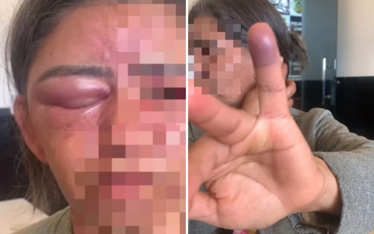 Mulher espancada por amigo do filho após sumiço de chave foi vítima de ‘extrema violência’, aponta laudo